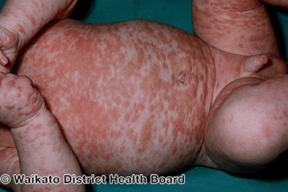 Rencic | mastocytosis-1