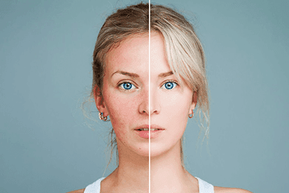 Rencic | accutane-isotretinoin3