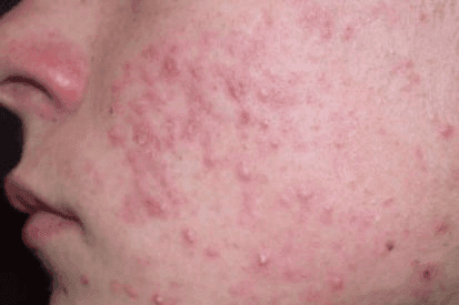 Rencic | accutane-isotretinoin2