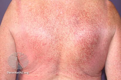 Rencic | mastocytosis-4