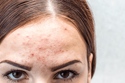 Rencic | accutane-isotretinoin1