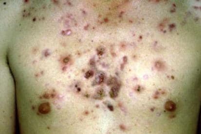 Rencic | acne-3