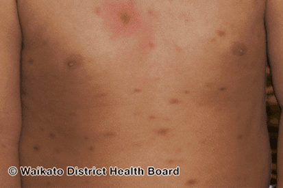 Rencic | mastocytosis-3